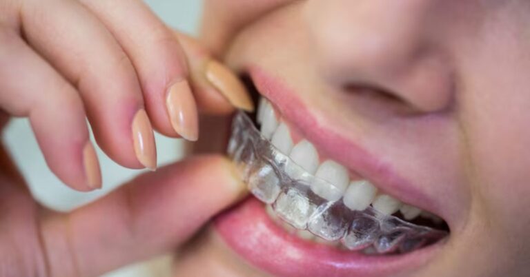 Invisalign Alternatives