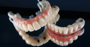 Preventive Resin Restoration